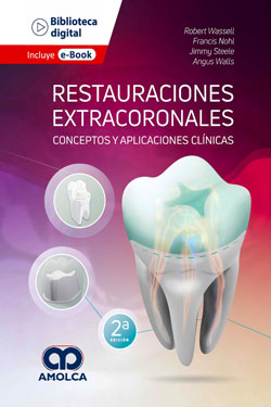 Restauraciones Extracoronales