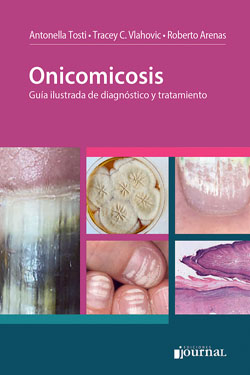 Onicomicosis