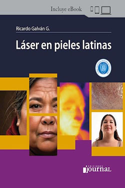 Láser en Pieles Latinas